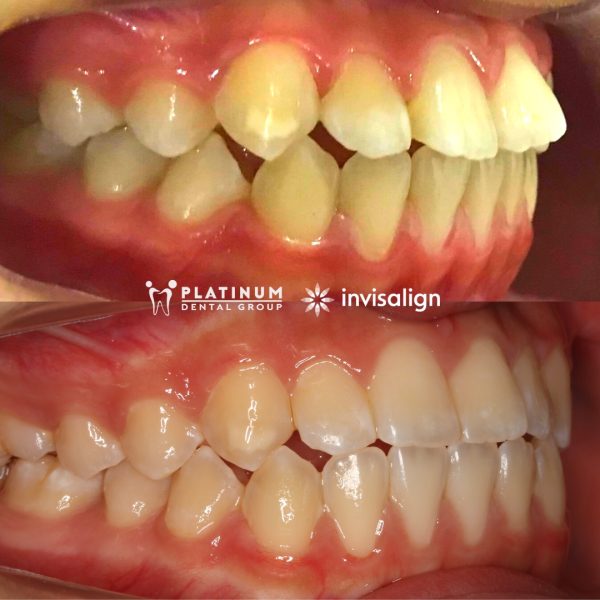 Dán răng sứ không mài - Giải pháp thẩm mỹ không xâm lấn 6 Với những người có răng hô, vẩu, khấp khểnh hoặc lệch lạc nặng, dán veneer không phù hợp, thay vào đó bệnh nhân nên niềng răng