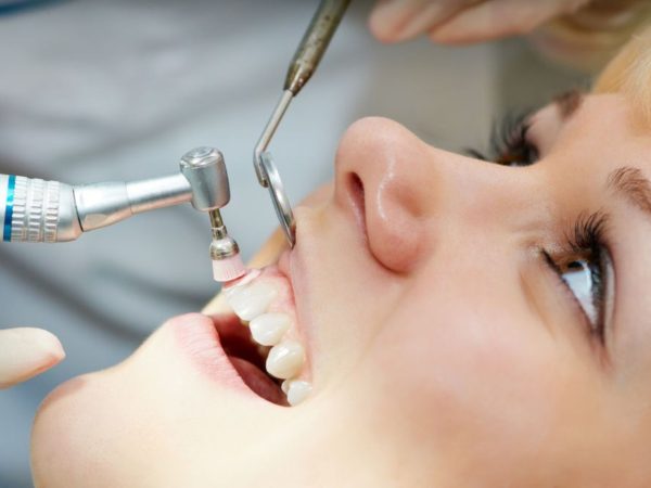 Dán răng sứ không mài - Giải pháp thẩm mỹ không xâm lấn 8 Trong một số trường hợp, bác sĩ có thể tiến hành làm nhám rất nhẹ trên bề mặt men răng để tạo độ bám cho mặt dán sứ