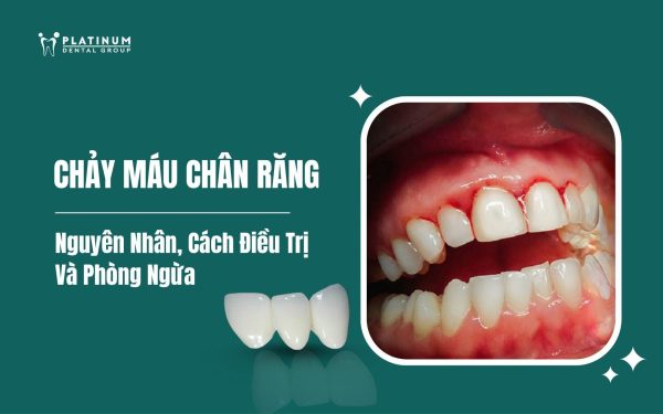 chảy máu chân răng