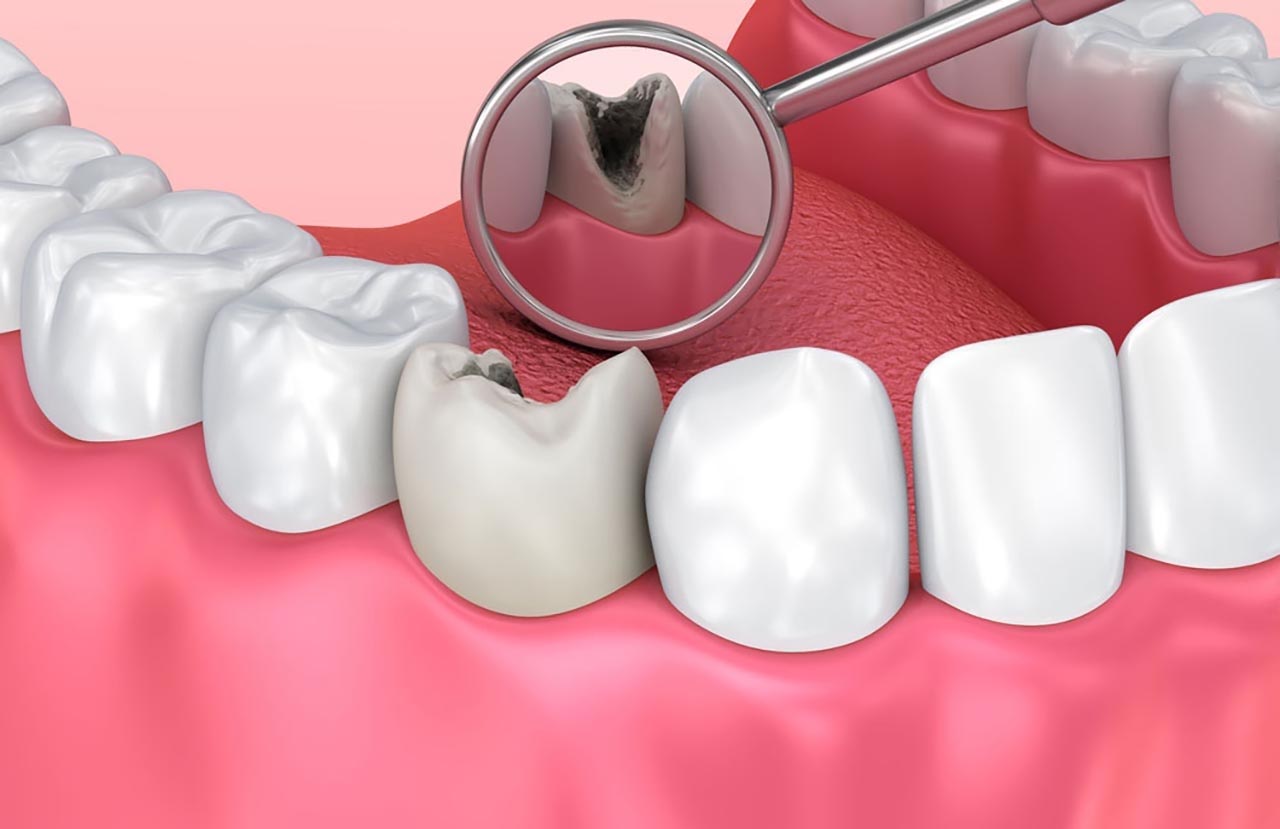 Sâu răng lâu ngày không được điều trị