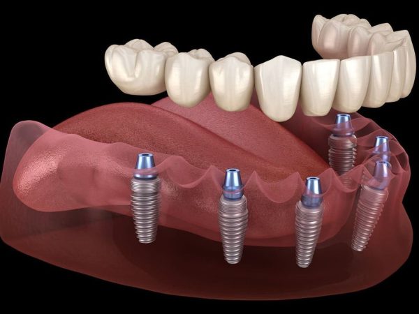 Mão sứ sẽ được gắn cố định lên trụ Implant