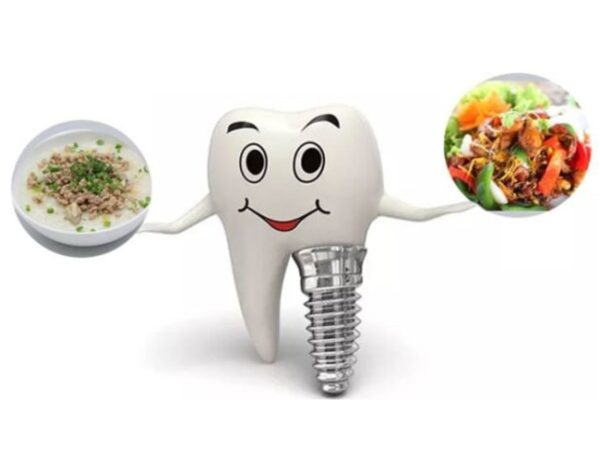 Trồng răng Implant bao lâu thì ăn được?