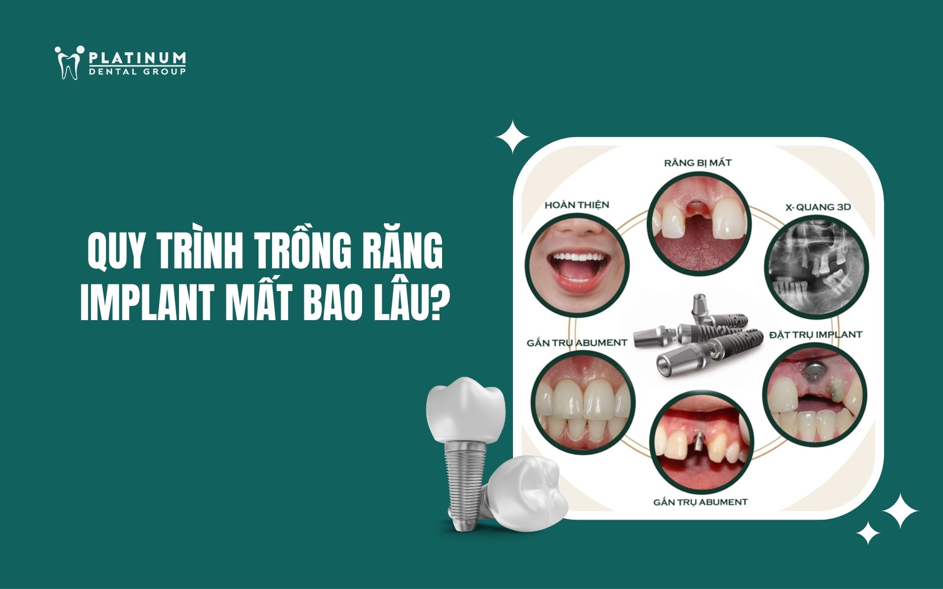 quy trình trồng răng Implant mất bao lâu