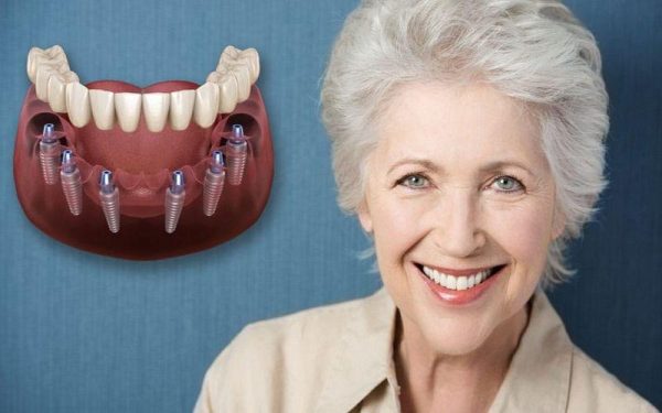 Trồng răng Implant cho người già có cần thiết?