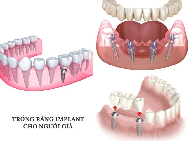Các phương pháp trồng Implant cho người già