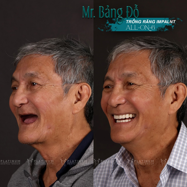 Tại sao nên trồng răng Implant cho người già?