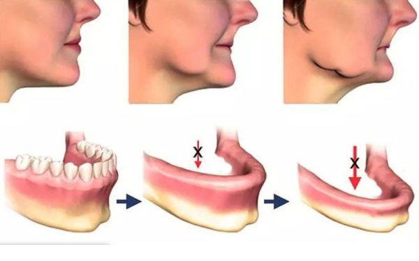 Ngăn ngừa tiêu xương hàm