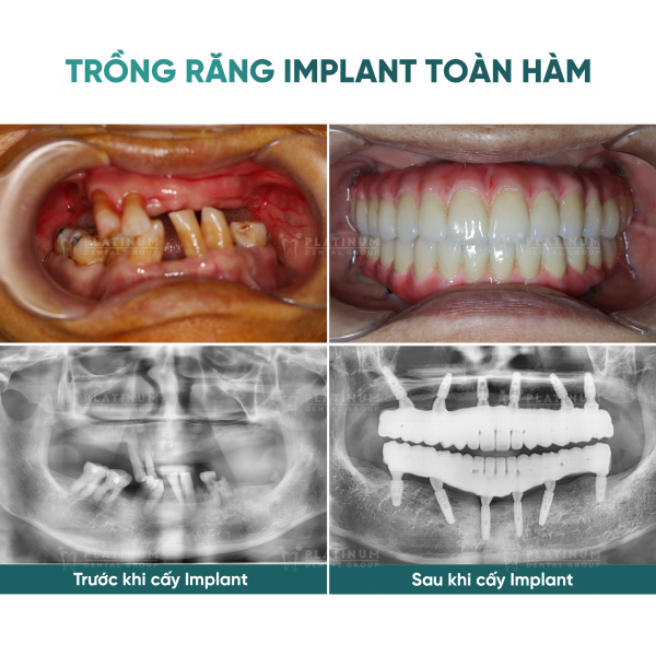 Trồng răng Implant toàn hàm sẽ có chi phí cao hơn trồng răng đơn lẻ
