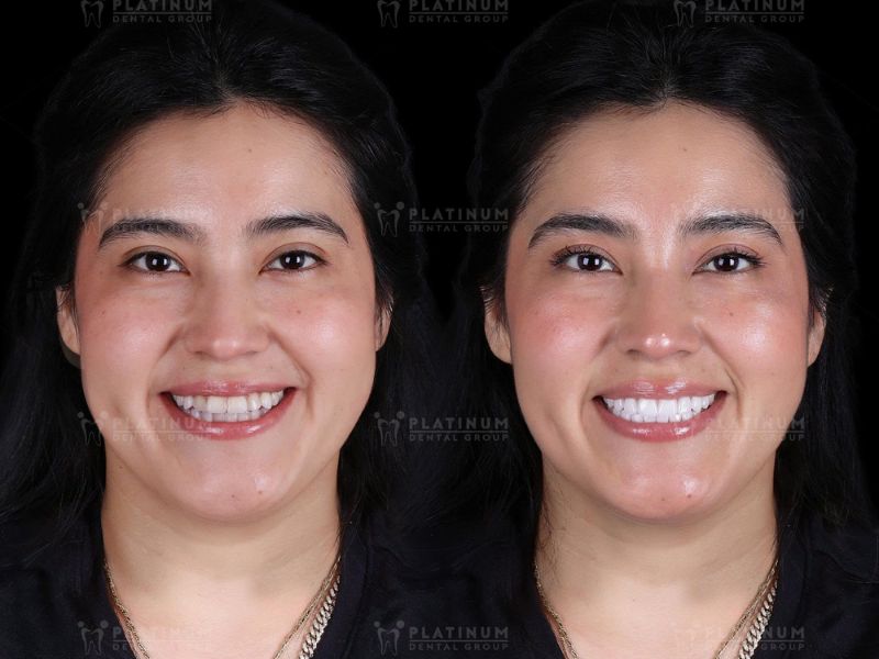 Ca dán Veneer thành công, đạt được độ thẩm mỹ tự nhiên được thực hiện tại Platinum Dental Group