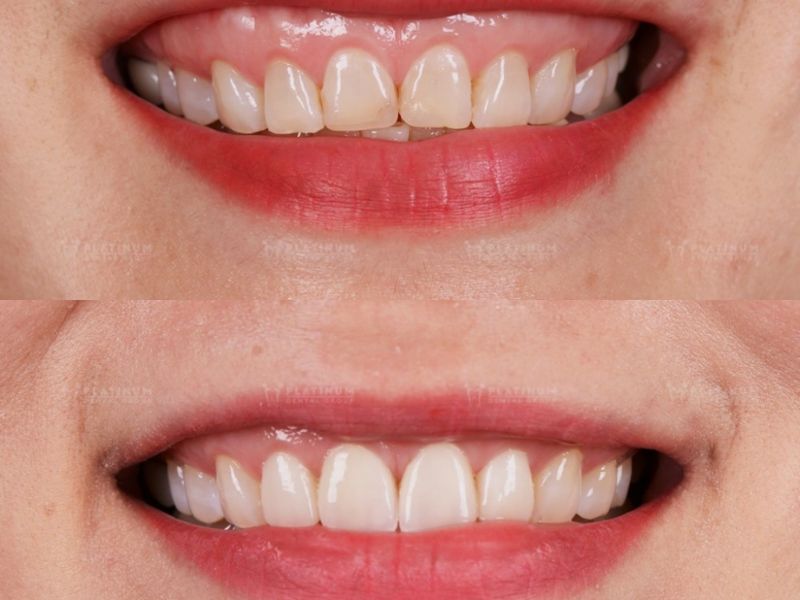 Để có được màu sắc Veneer tự nhiên, hài hòa bác sĩ Platinum Dental Group đã nghiên cứu màu sắc da, màu sắc môi cùng màu tóc của khách hàng trước khi tư vấn lựa chọn màu sứ cho khách hàng.