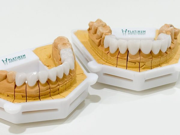Răng sứ bị hở: Dấu hiệu, nguyên nhân và cách khắc phục hiệu quả 9 Lấy dấu hàm lại và chế tác mão sứ mới theo chỉ định của bác sĩ