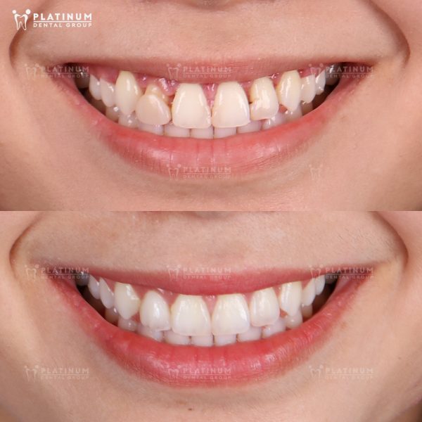 Răng sứ bị hở: Dấu hiệu, nguyên nhân và cách khắc phục hiệu quả 10 Keo dán đóng vai trò quyết định trong việc giúp mão sứ bám chặt vào cùi răng