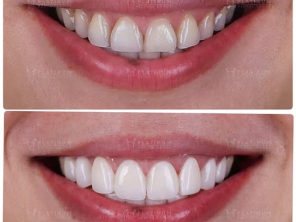 Răng sứ bị hở: Dấu hiệu, nguyên nhân và cách khắc phục hiệu quả 10 Keo dán đóng vai trò quyết định trong việc giúp mão sứ bám chặt vào cùi răng