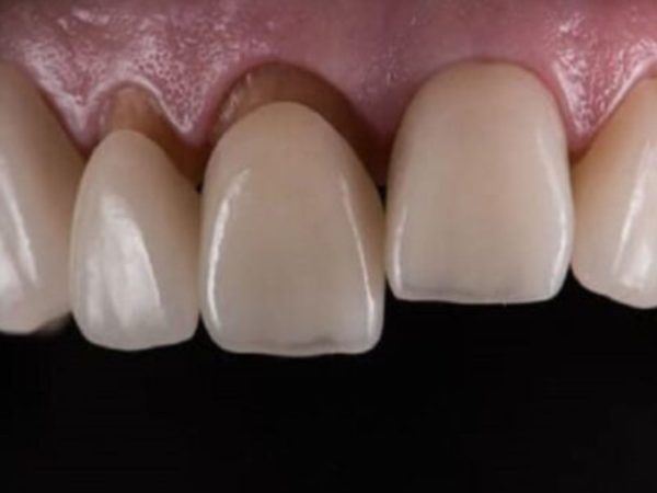 Răng sứ bị hở: Dấu hiệu, nguyên nhân và cách khắc phục hiệu quả 4 Mão sứ sai kích thước cũng là nguyên nhân gây ra tình trạng hở răng sứ