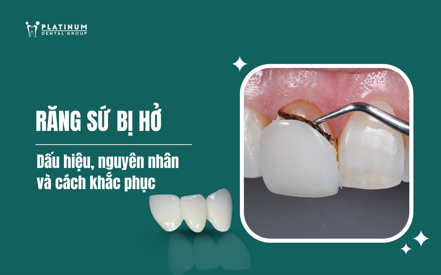 răng sứ bị hở