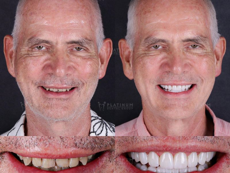 Mr. Michael Osswald lột xác với nụ cười trắng sáng sau khi phục hình 15 răng bằng sứ Veneer