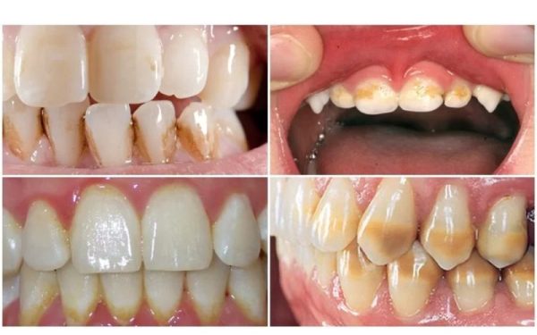 Chân Răng Bị Vàng: Nguyên Nhân Và Tác Hại Và Cách Phòng Ngừa 30 Nguyên nhân khiến chân răng bị vàng