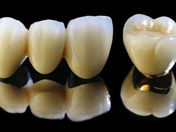 Răng sứ kim loại thường có phần khung sườn làm từ hợp kim