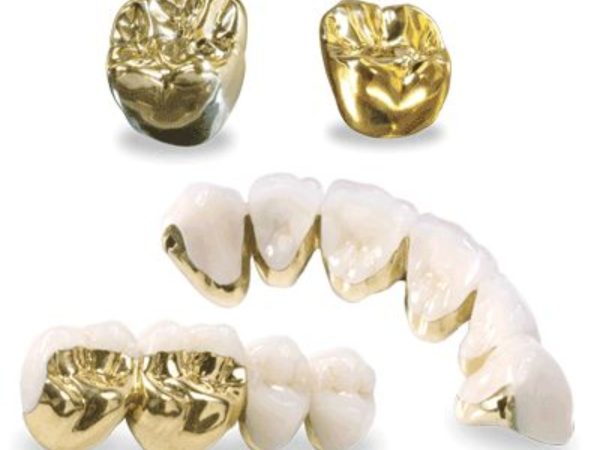 Răng sứ kim loại là loại răng này có khung sườn làm từ các kim loại quý