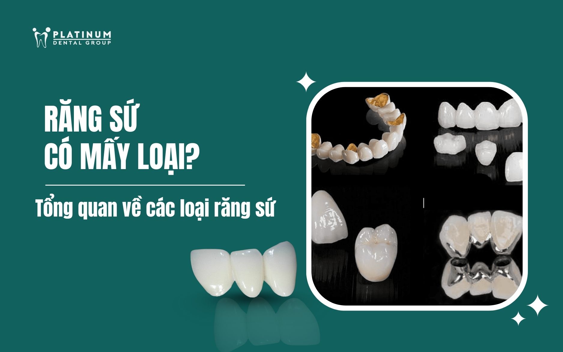 răng sứ có mấy loại