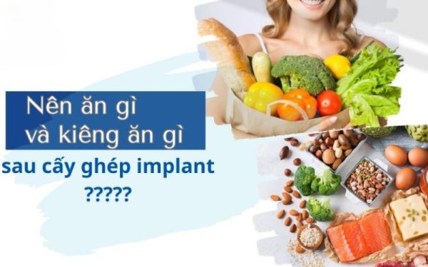 Trồng răng Implant kiêng ăn gì, nên ăn gì để nhanh lành?
