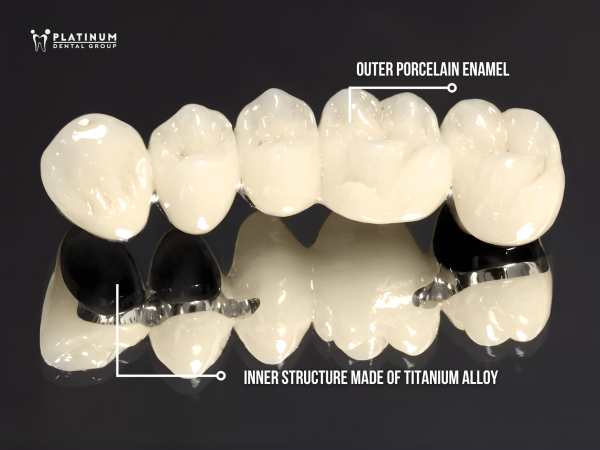 How many types of dental Crowns are there? An overview of dental Crown types 2 Titanium crowns have a framework made of a Titanium alloy that is coated with porcelain