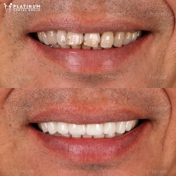 How many types of dental Crowns are there? An overview of dental Crown types 1 Non-precious metal crowns have a framework made from an alloy