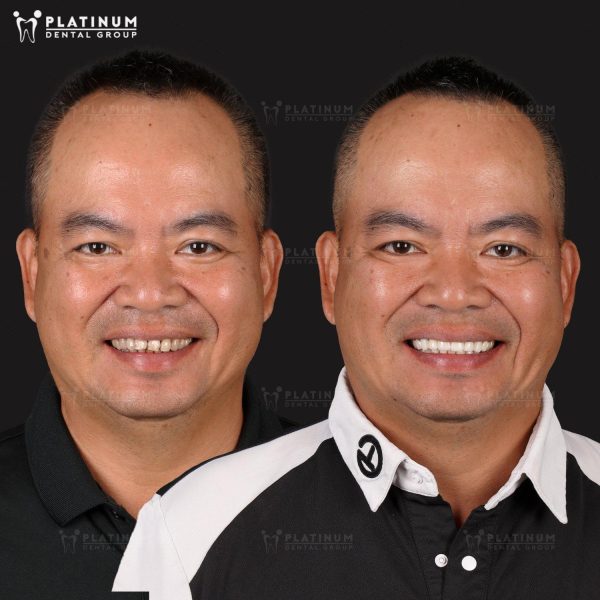 How many types of dental Crowns are there? An overview of dental Crown types 4 All-ceramic crowns are made entirely from a solid block of porcelain and contain no metal