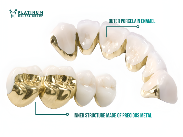 How many types of dental Crowns are there? An overview of dental Crown types 3 Precious metal crowns have a framework made from precious metals