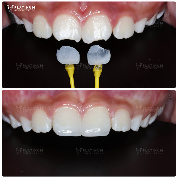 How many types of dental Crowns are there? An overview of dental Crown types 5 A porcelain veneer is an ultra-thin layer of porcelain that is bonded to the outer surface of the tooth