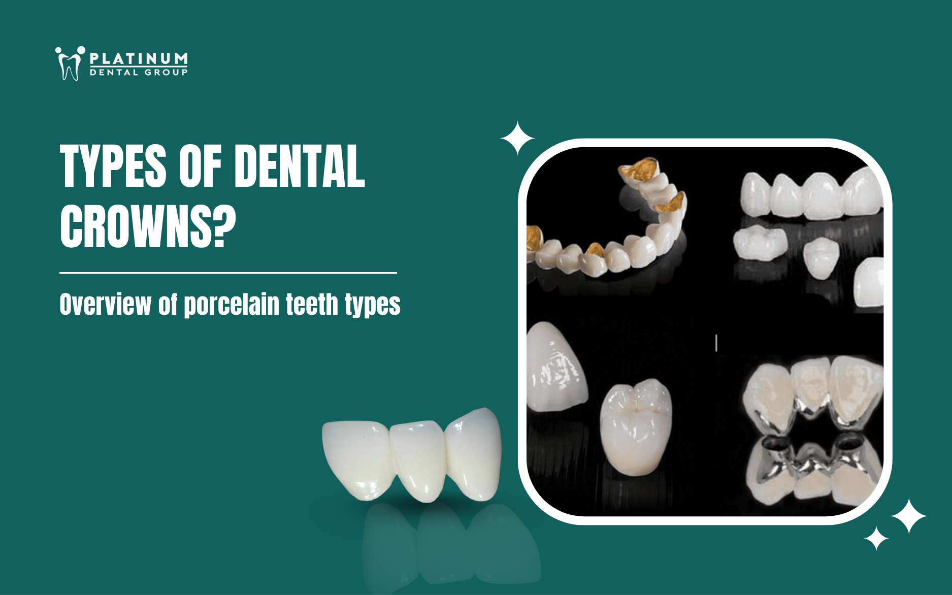 types of dental crowns
