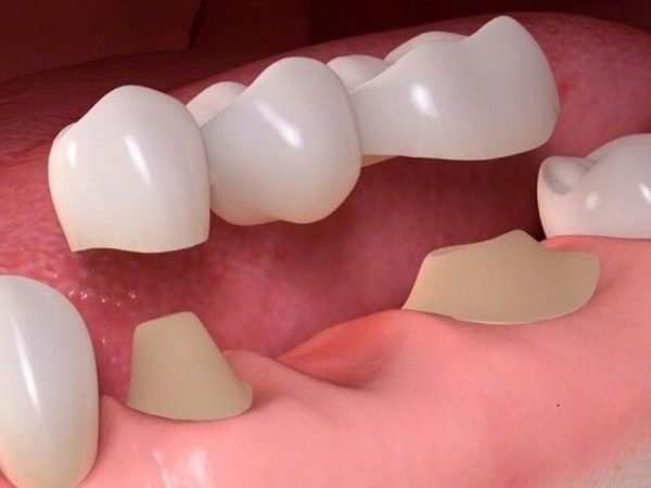 Cầu răng sứ là phương pháp phục hình răng đã mất bằng cách gắn một chiếc cầu vào các răng thật còn lại ở hai bên vị trí mất răng