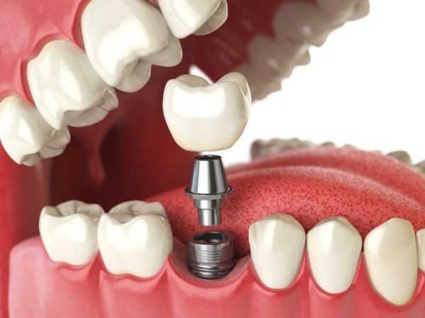 Trồng Implant là phương pháp hiện đại trong phục hình răng miệng