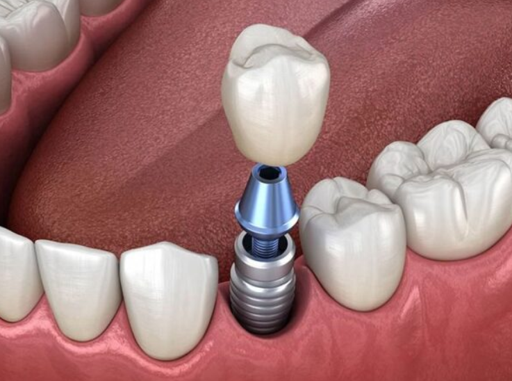 Trồng răng Implant bắt vít là gì? 