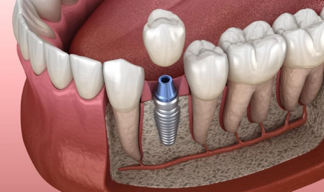 Trồng răng Implant bắt vít có những kỹ thuật nào? 