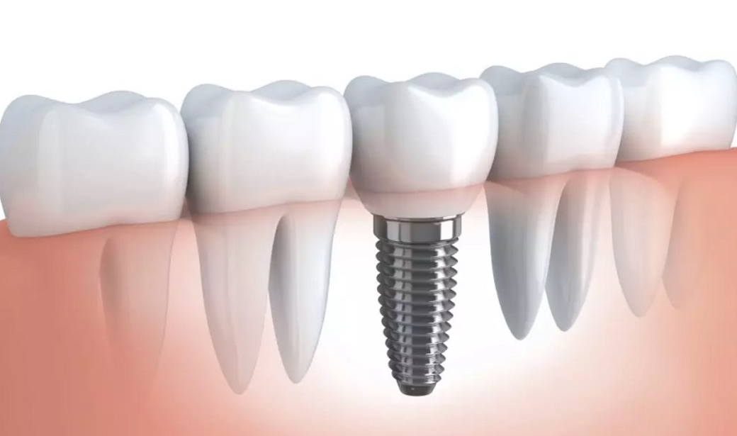 Ưu điểm của trồng răng Implant bắt vít 