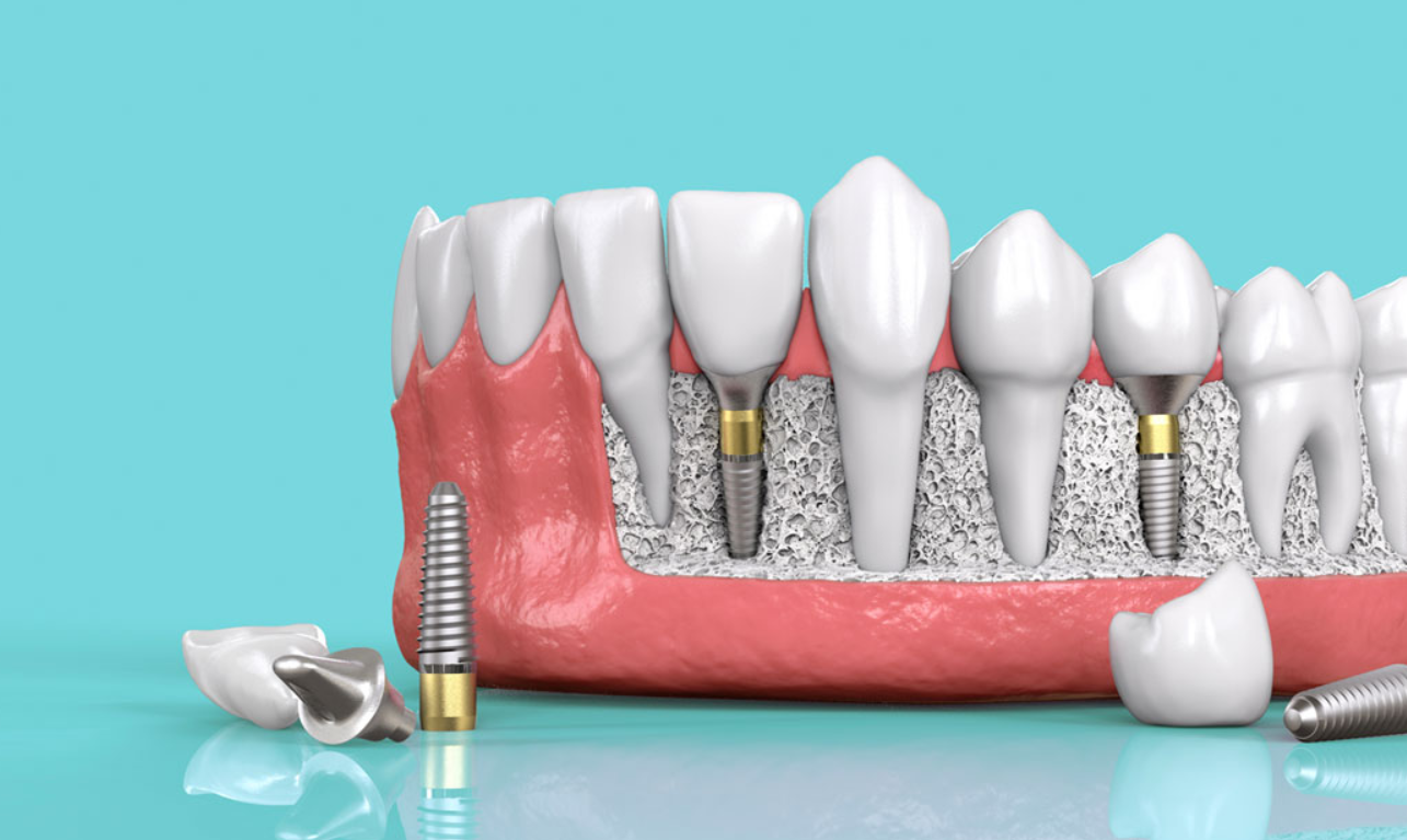 Platinum Dental - Địa chỉ trồng răng Implant bắt vít uy tín