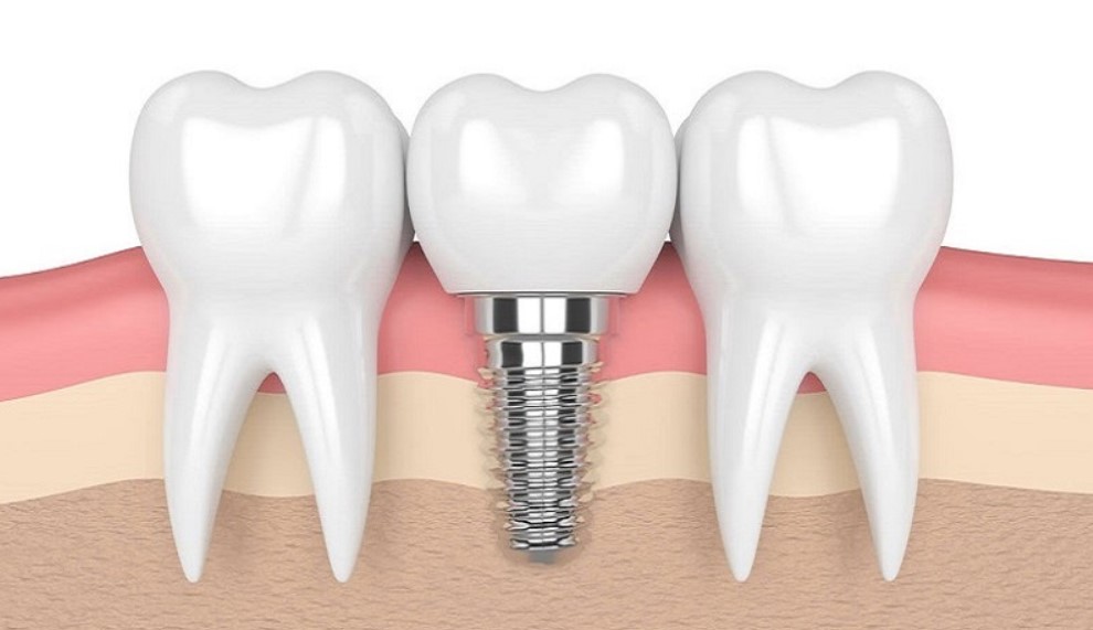 răng tạm trên Implant