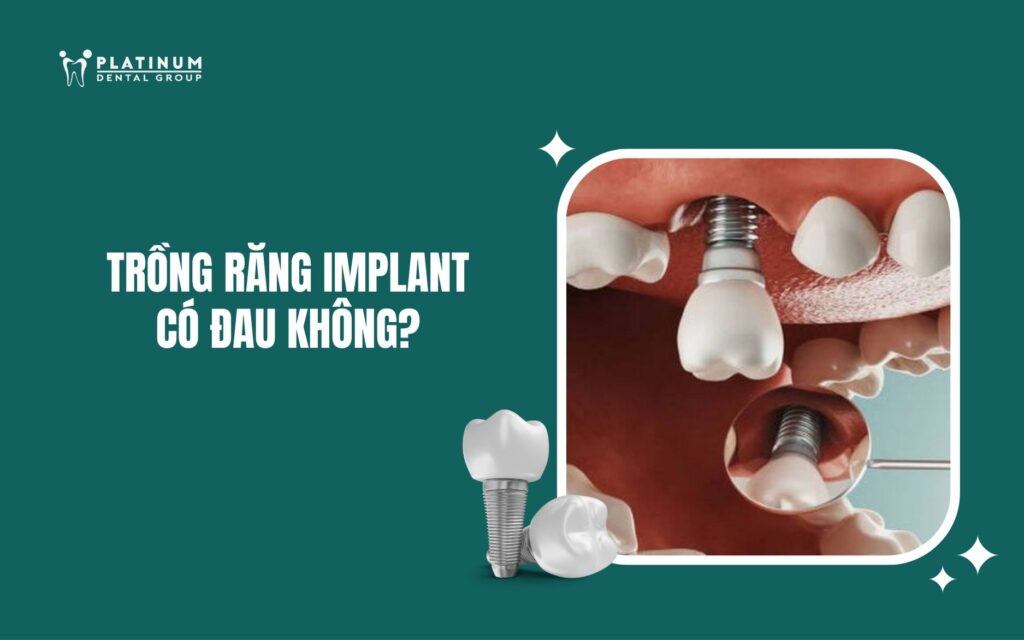 Trồng răng Implant có đau không? Giải đáp từ chuyên gia và cách giảm đau hiệu quả