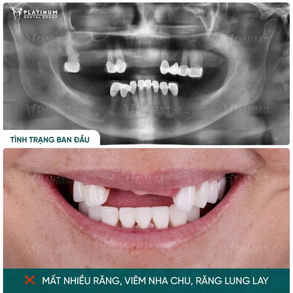 Tình trạng răng ban đầu của cô Viện.