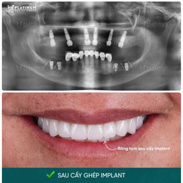 Sau cấy ghép Implant và có hàm tạm.