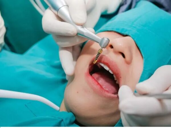 Bác sĩ đặt trụ Implant vào vị trí đã được xác định trên xương hàm và tiến hành phục hình tạm