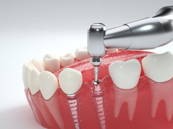 Sau khi trồng răng implant bao lâu thì hết đau?