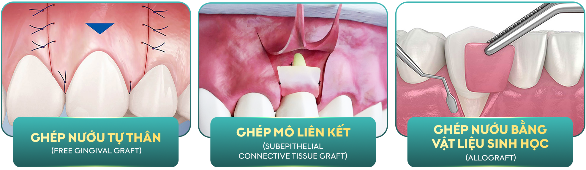 GHÉP LỢI CẢI THIỆN NƯỚU TỤT VÀ BẢO VỆ CHÂN RĂNG HIỆU QUẢ