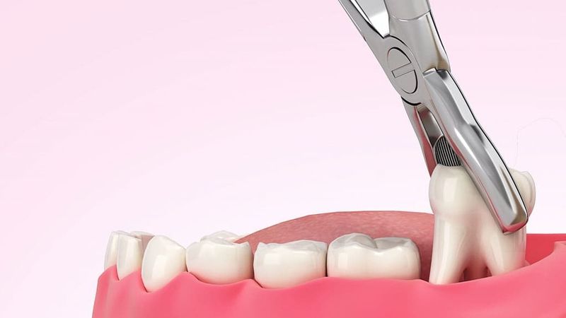 Nhổ răng khôn - Platinum Dental Group Nhổ răng khôn - Platinum Dental Group