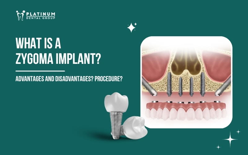Zygomatic Implant