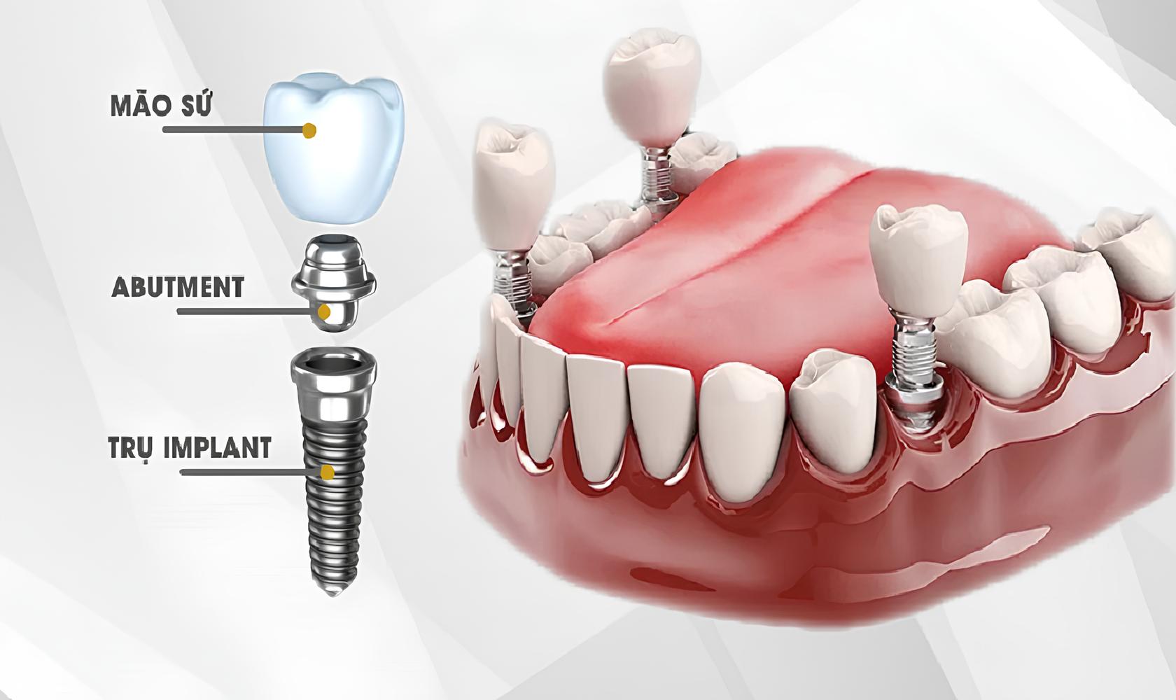 Trồng răng Implant là gì? Dịch vụ Implant uy tín tại TPHCM