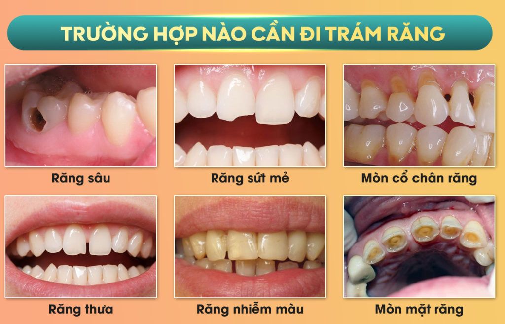 cac truong hop tram