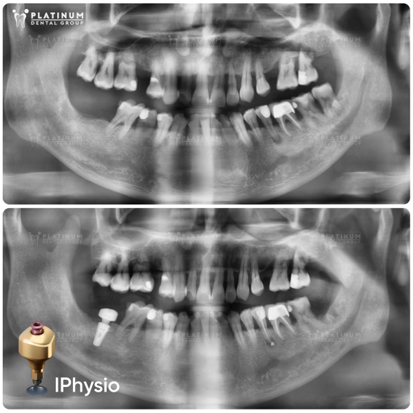 Tình trạng xương hàm và mô nướu là các yếu tố ảnh hưởng đến chi phí trồng Implant cho người mất răng lâu năm