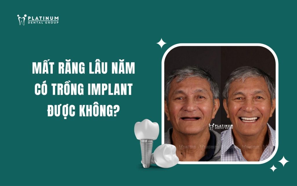 mất răng lâu năm có trồng implant được không